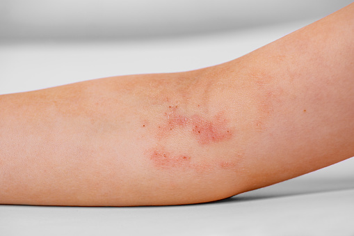 dermatitis atópica en el brazo del niño photo
