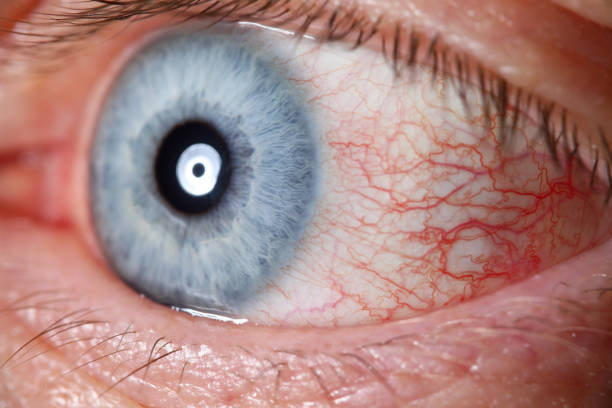 istock Irritated male blue eye full with capillar net 1395595423