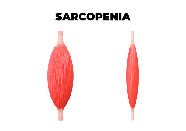 Sarcopenia is the loss of muscle mass, a common occurrence after age 50 Sarcopenia is the loss of muscle mass, a common occurrence after age 50. 3D illustration atrophy photos stock pictures, royalty-free photos & images