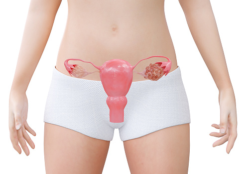 Polycystic Ovary Syndrome A hormonal disorder that causes an increase in the size of the ovaries with small cysts on the outside of the ovaries. 3D illustration