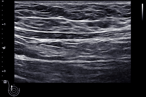 ultrasound  breast of Patient after mammogram  for diagnosis Breast cancer in women isolated on black background.
