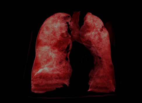 Lung 3D rendering image for diagnosis TB,tuberculosis and covid-19 from CT-Scanner 3D.