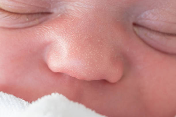 acné miliaire sur le nez d’un nouveau-né. éruptions cutanées, taches et petits boutons sur le corps d’un enfant à la naissance. santé du nourrisson et soins du corps - baby beauty beautiful the human body photos et images de collection