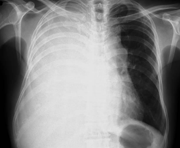 istock Pleural effusion in chest x-ray 1395876466