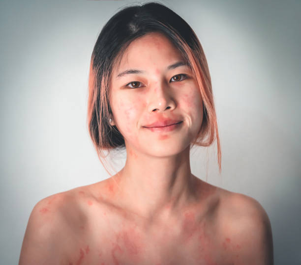 Asian woman suffering from Skin allergy from Cosmetic and Make up making her skin all over the body red itchy and painful. stock photo