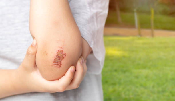child showing an injured elbow Close up of a child showing an elbow injury outdoors skin scrape stock pictures, royalty-free photos & images