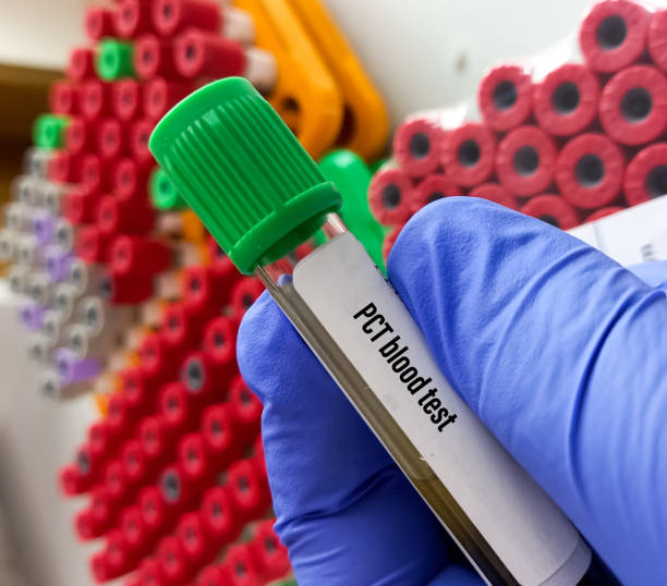 istock Biochemist or Lab Technologist holds blood samples for PCT(Procalcitonin) test, diagnosis of severe sepsis. 1395990519