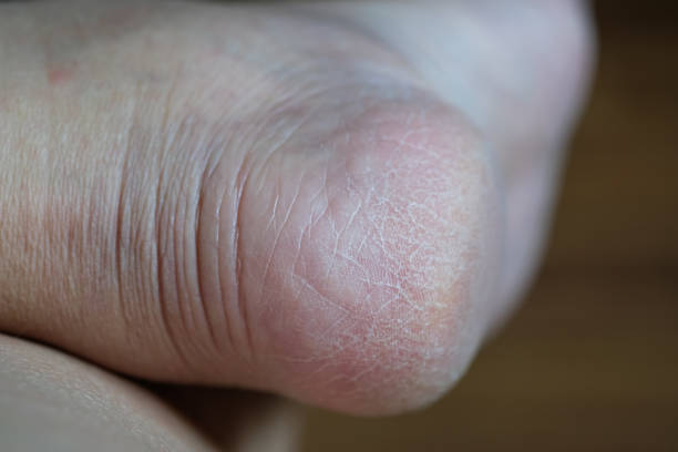 istock Dry cracked heels or a callus. 1396382437
