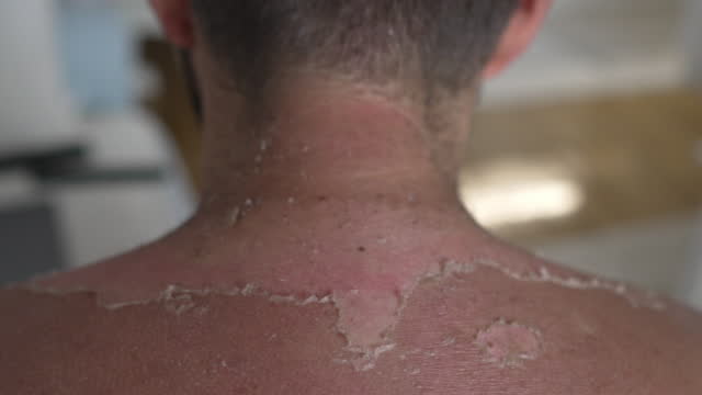 Homme méconnaissable brûlé par le soleil au dos et au cou, avec de petites  taches de peau pelée Clip Vidéo 1396447200