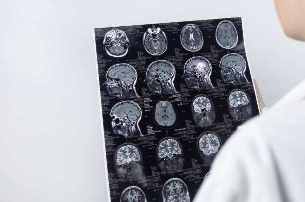 ressonância magnética do cérebro. o neuropatologista tem uma imagem no fundo de um dispositivo de luz para ver patologias e lesões cerebrais. diagnóstico e tratamento de neuralgia, epilepsia e outras patologias - neuropathologist - fotografias e filmes do acervo