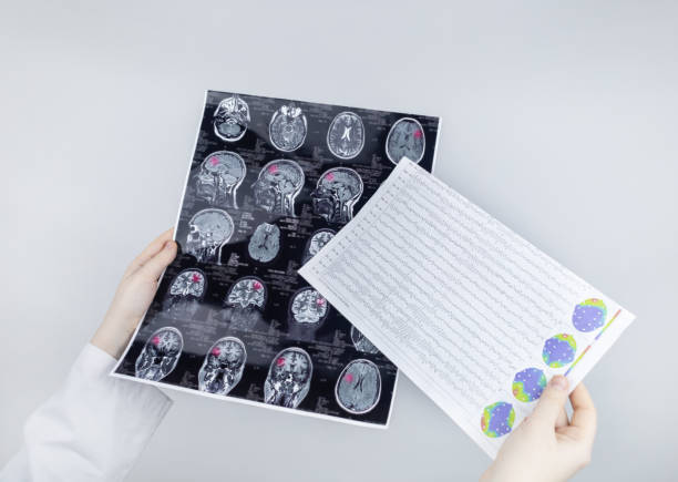 epileptolog bada mri pacjenta i elektroencefalogram. koncepcja leczenia padaczki i pomocy osobom cierpiącym na tę chorobę. neurolog w pracy. patologia mózgu. aktywność napadowa - neuropathologist zdjęcia i obrazy z banku zdjęć