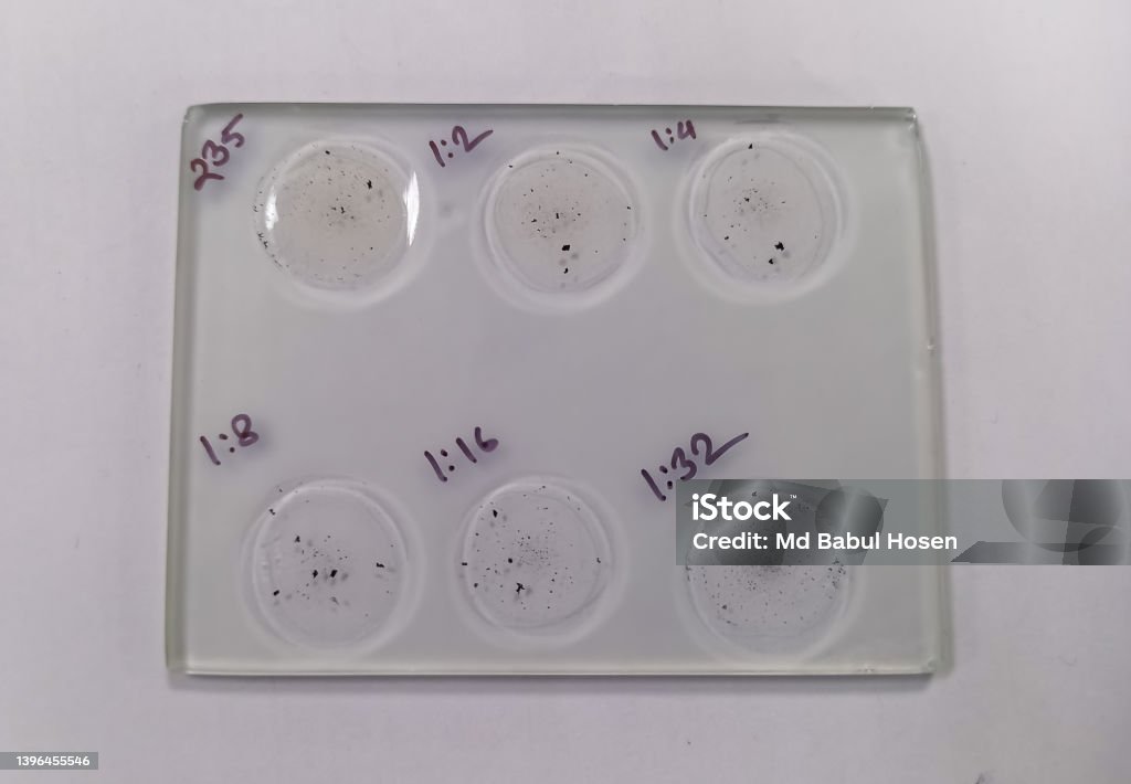 Syphilis Rpr Reactive Rpr Vdrl Syphilis Test Glass Slide Agglutination Method Showing Highly ...
