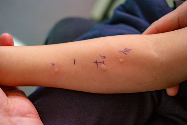 Skin Prick Allergy Test on a little child's arm Skin Prick Allergy Test on a little child's arm,  positive results closeup allergy test stock pictures, royalty-free photos & images