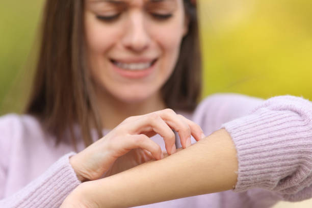 Stressed teen scratching itchy arm in a park stock photo