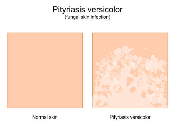 Pityriasis versicolor. fungal skin infection. tinea versicolor. Pityriasis versicolor. fungal skin infection. comparison of Healthy skin and tinea versicolor. Vector illustration tinea stock illustrations