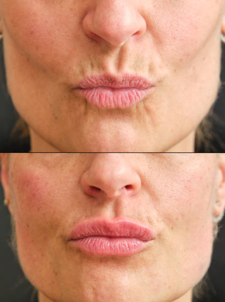 before and after lips with botulinum toxin image divided into two parts showing the before and after of a botulinum toxin lip augmentation treatment botox-before-and-after-lips stock pictures, royalty-free photos & images