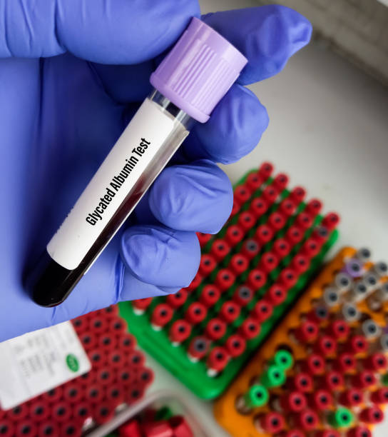 istock Blood sample for Glycated Protein test or Fructosamine test that measures average blood glucose levels over the two or three weeks. 1396584907