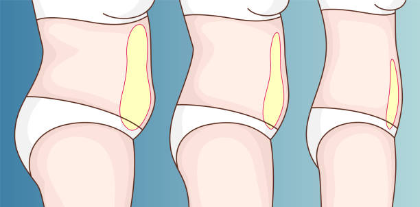 Can Visceral Fat Be Surgically Removed Can Visceral Fat Be Surgically Removed