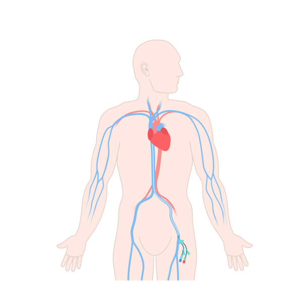 ilustraciones, imágenes clip art, dibujos animados e iconos de stock de catéter venoso de la línea central femoral en el cuerpo masculino - surgery catheter cardiac catheterization hospital