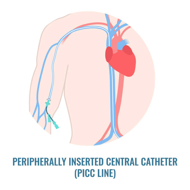 ilustraciones, imágenes clip art, dibujos animados e iconos de stock de catéter central insertado periféricamente línea picc de cerca - arteria femoral