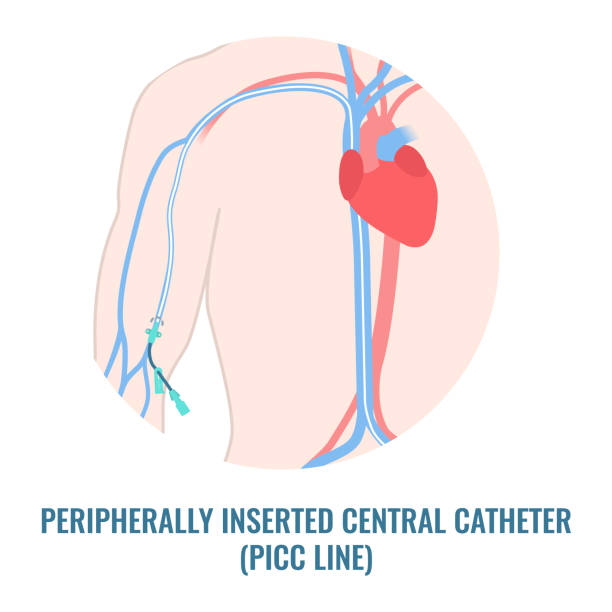 периферически вставленный центральный катетер picc линии крупным планом - зонд stock illustrations