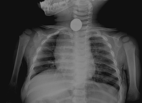 chest x ray showing coin in the neck.corpus alienum on esophagus