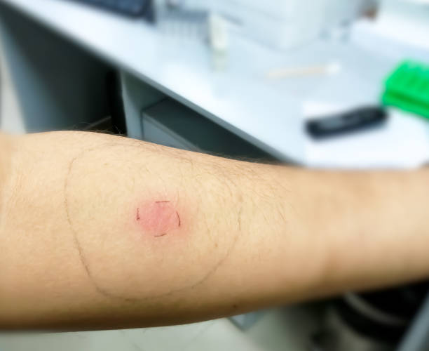 Mantoux vaccination, Closeup view photography of patient arm with red spot reaction to conducting Mantoux test. Positive tuberculosis patient. stock photo