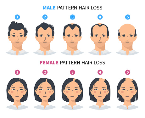 Hair loss stages, androgenetic alopecia male and female pattern. Steps of baldness vector infographic in a flat style with a man and a woman. MPHL and FPHL