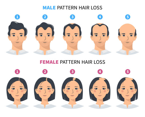 Hair loss stages, androgenetic alopecia male and female pattern Hair loss stages, androgenetic alopecia male and female pattern. Steps of baldness vector infographic in a flat style with a man and a woman. MPHL and FPHL woman hairline stock illustrations