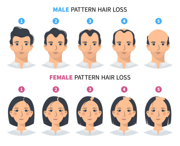 Hair loss stages, androgenetic alopecia male and female pattern Hair loss stages, androgenetic alopecia male and female pattern. Steps of baldness vector infographic in a flat style with a man and a woman. MPHL and FPHL shaved bald stock illustrations