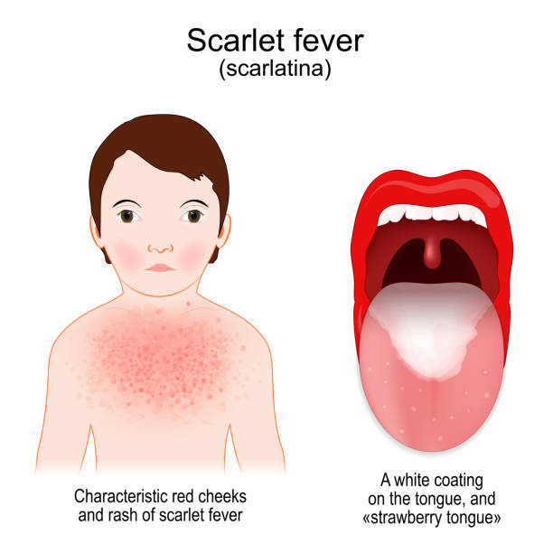 Scarlet Fever Stock Illustration - Download Image Now - Fever,  Staphylococcus Aureus, Child - iStock