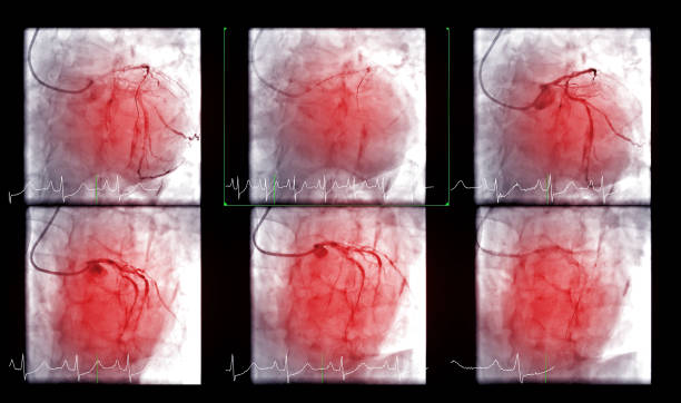 el cateterismo cardíaco es una prueba que se utiliza para determinar el paro cardíaco. - surgery catheter cardiac catheterization hospital fotografías e imágenes de stock