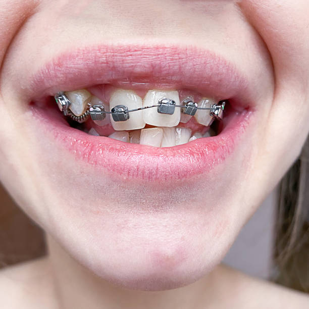 istock orthodontic treatment of teeth with braces close up 1397005163