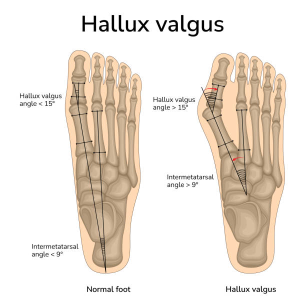 Illustration of Hallux valgus An illustration of the location of the bones in a healthy foot and hallux valgus. The angles of the bones relative to each other are indicated sports medicine stock illustrations