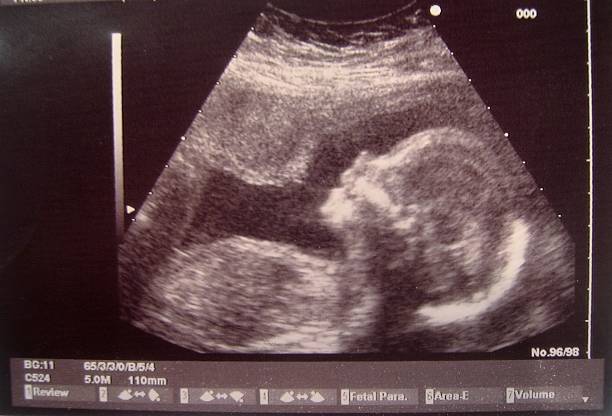 istock Ultrasonic baby 139705699