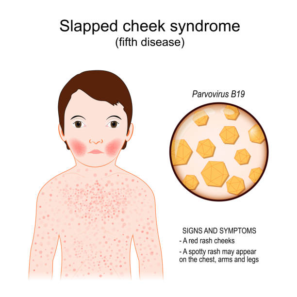 ilustraciones, imágenes clip art, dibujos animados e iconos de stock de el niño tiene síndrome de mejilla abofeteada. enfermedad infecciosa. primer plano del parvovirus b19. - abofetear