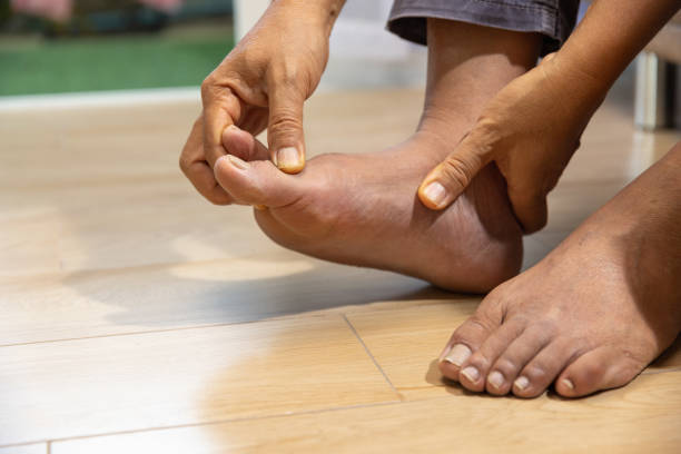 senior man massage foot with painful swollen gout inflammation - on his toes imagens e fotografias de stock