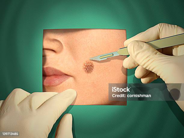 Operation Stockfoto und mehr Bilder von Leberfleck - Hautmerkmal - Leberfleck - Hautmerkmal, Menschliches Gesicht, Arzt