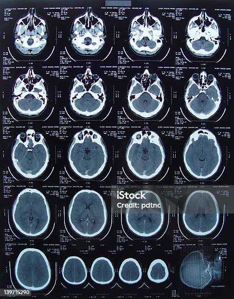 Ct Scan Skull Slices Stock Photo - Download Image Now - CAT Scan, Data, Healthcare And Medicine