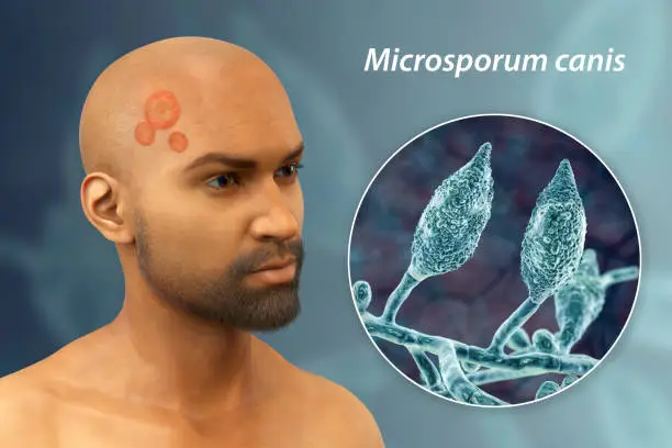 Microsporum canis fungal infection on a man's head and close-up view of Microsporum canis fungi, 3D illustration. Ringworm, Tinea capitis