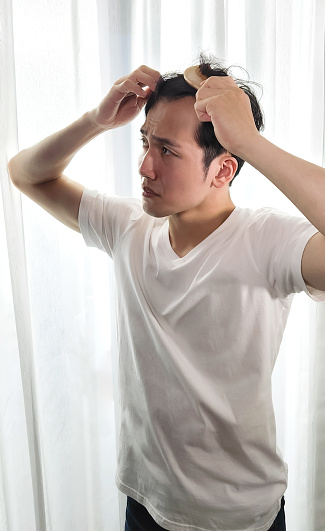 asian man worried for hair loss combing his receding hairline with brush