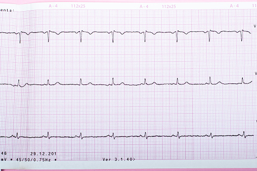 EKG showing Normal Sinus Rythm of the heart.