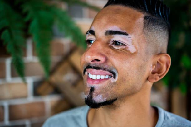 Portrait of a man with vitiligo