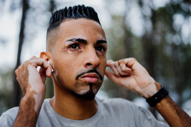 Portrait of a man with vitiligo