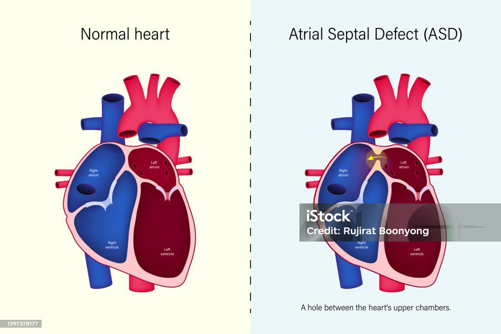 The Difference Of Normal Heart And Atrial Septal Defect Vector Congenital  Heart Defect Stock Illustration - Download Image Now - iStock