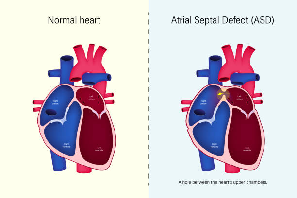 The difference of normal heart and atrial septal defect (ASD) vector. Congenital heart defect. The difference of normal heart and atrial septal defect (ASD) vector. Congenital heart defect. heart ventricle stock illustrations