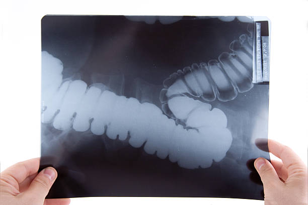 Doctor examining an abdominal x-ray A doctor examining an abdominal x-ray colon photos stock pictures, royalty-free photos & images
