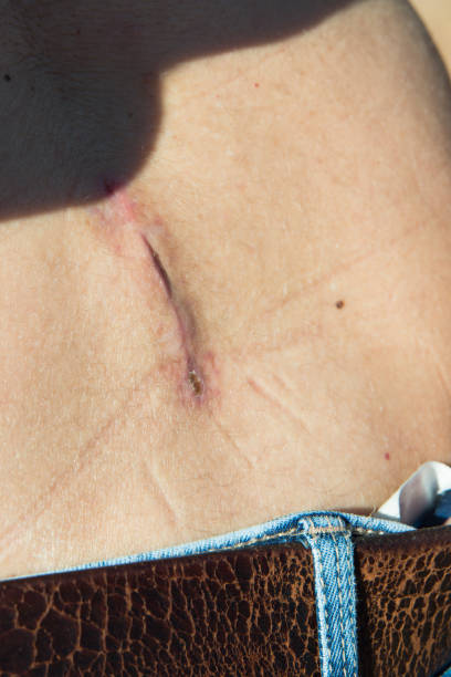 Surgical scar on the spine Close up of a surgical scar on the spine of a caucasian woman. Cyst removal. Outdoors scar surgery rear view human spine stock pictures, royalty-free photos & images