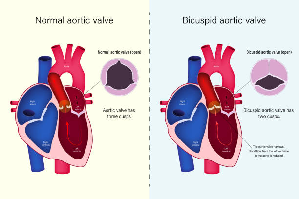 разница нормального сердечного клапана и двустворчатого вектора аортального клапана. врожденные пороки сердца. сужение аортального клапа - premolar stock illustrations