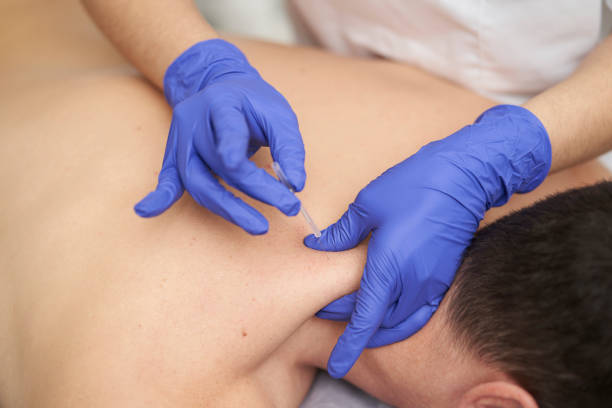 physiotherapist treating an overload with dry needling stock photo